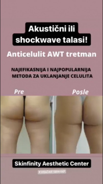 Anticelulit tretmani